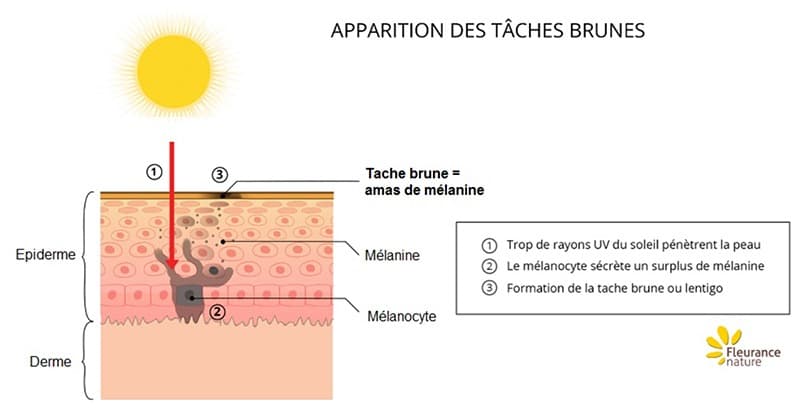 Schéma expliquant le processus d'apparition de tâches brunes sur la peau à cause du soleil