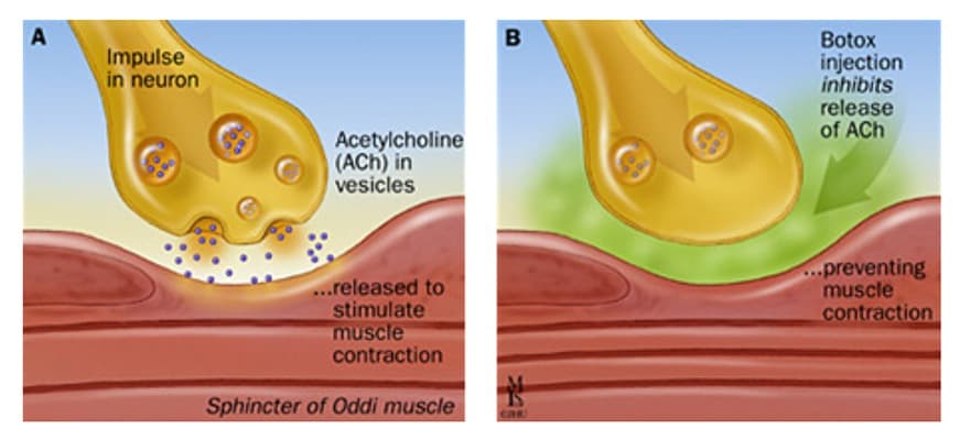 Schéma explicatif sur le fonctionnement du botox en médecine esthétique