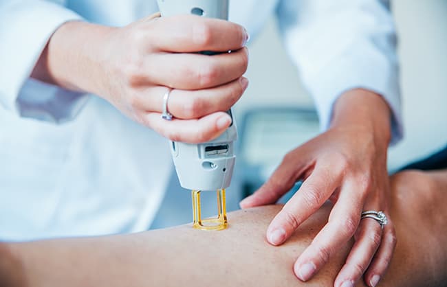 Le Dr Emma Lavocat en pleine séance d'épilation dans son cabinet de Bordeaux