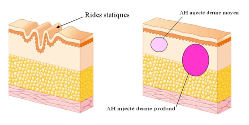 Schéma explicatif du fonctionnement de l'acide hyaluronique en médecine esthétique