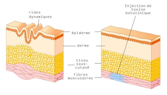 Schéma expliquant le fonctionnement des injections d'acide hyaluronique sur les différentes couches de la peau
