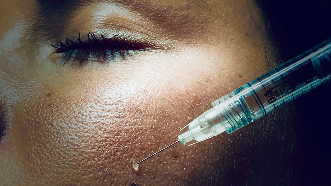 Gros plan sur une seringue d'acide hyaluronique avant une injection dans le visage par le Dr Emma Lavocat à Bordeaux