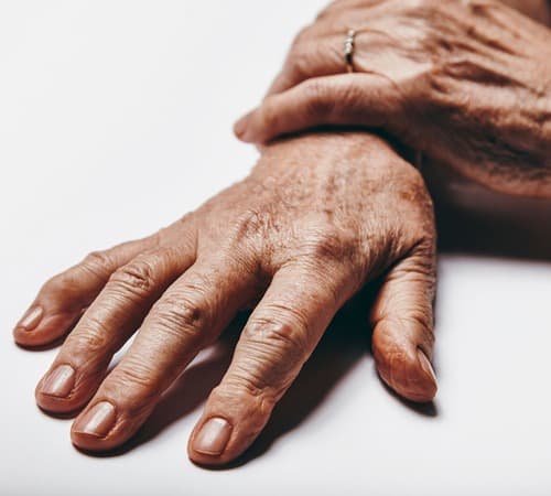 Gros plan sur des mains avec des taches pouvant être traitées par laser pigmentaire