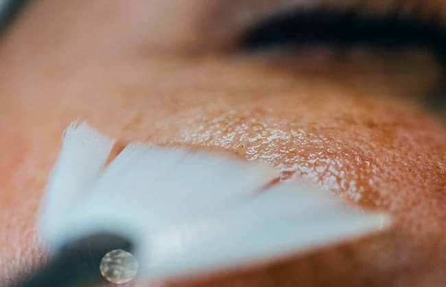 Gros plan d'application d'un peeling pour lutter contre l'acné par le Dr Emma Lavocat à Bordeaux