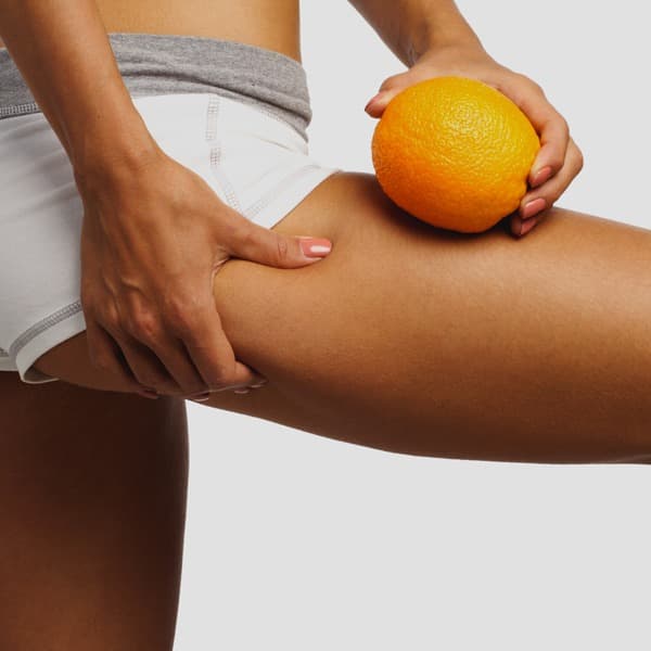 Une femme tient une orange contre sa peau pour illustrer l'effet peau d'orange causé par la cellulite