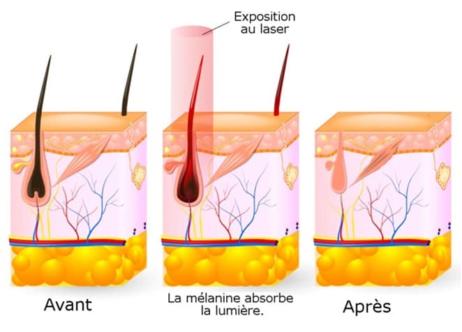Schéma explicatif des effets de l'épilation par laser sur le poil