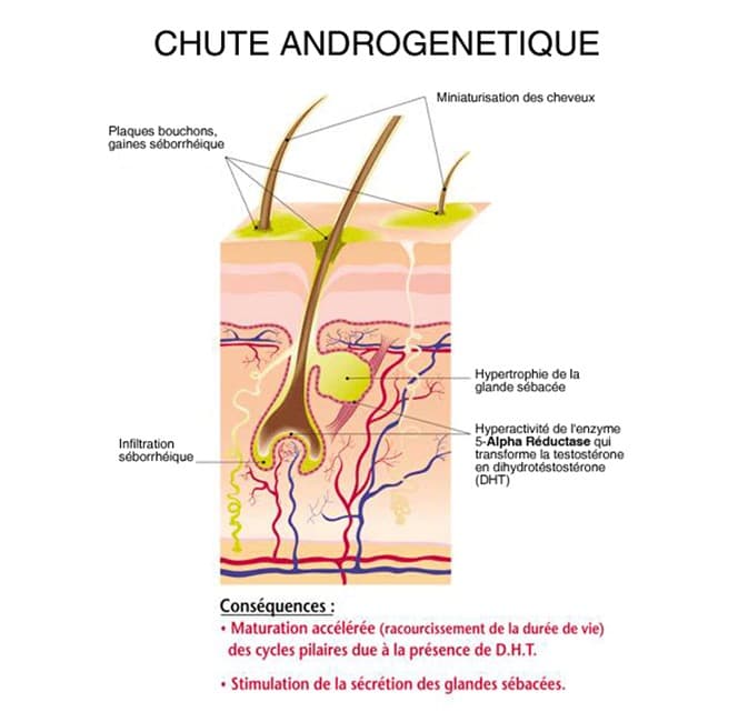 Schéma expliquant le processus de chute de cheveu de type androgénétique