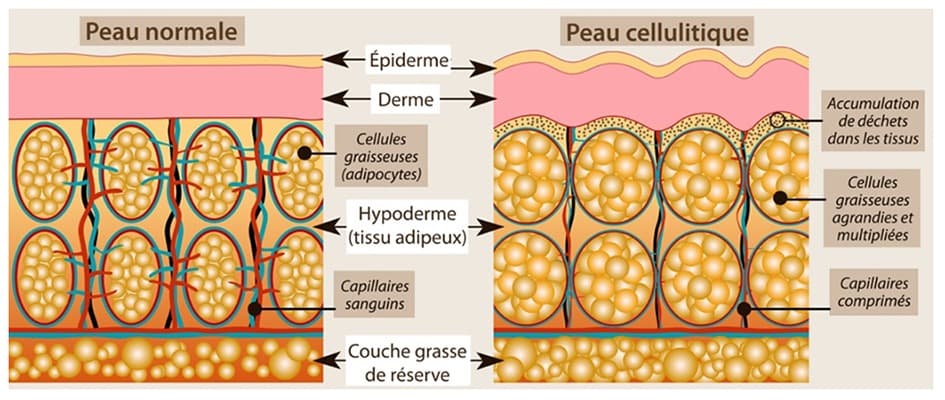Schéma marquant les différences anatomiques entre une peau lisse et une peau avec cellulite