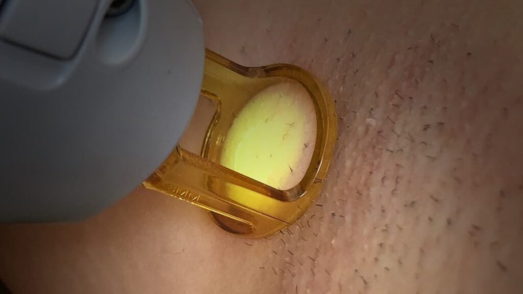 Gros plan sur l'épilation laser des aisselles par le Dr Emma Lavocat à Bordeaux
