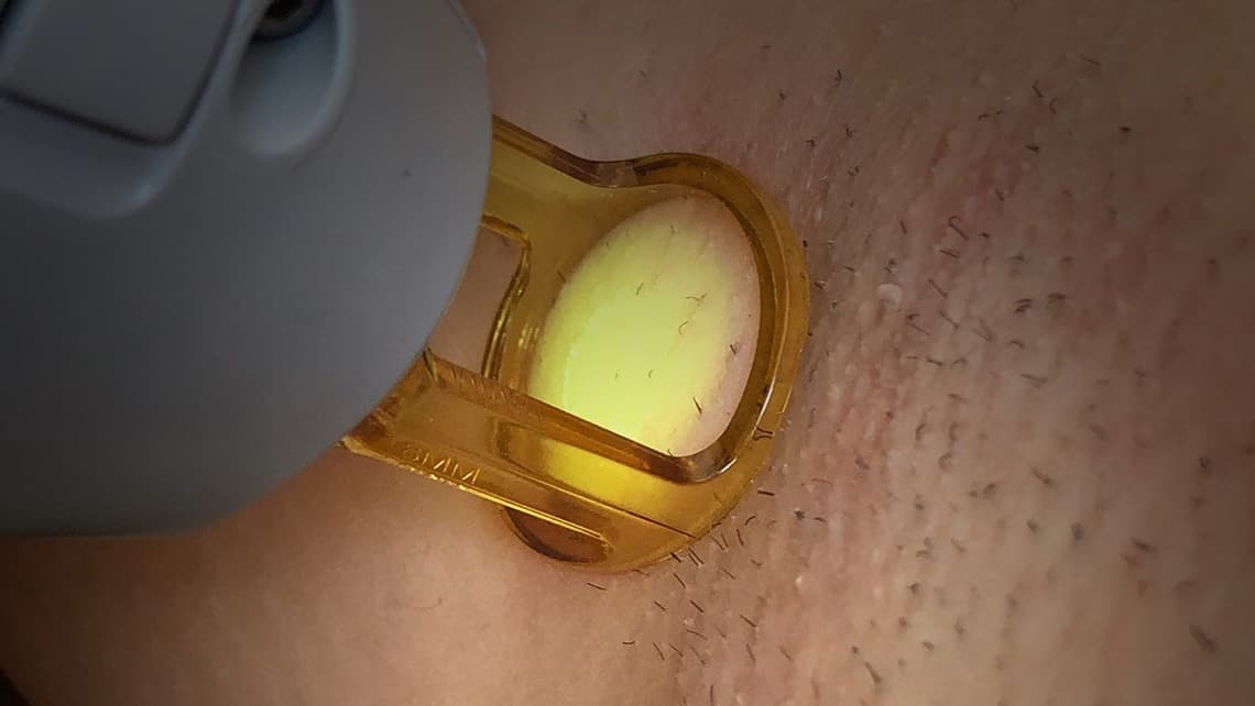 Gros plan sur l'épilation laser des aisselles par le Dr Emma Lavocat à Bordeaux