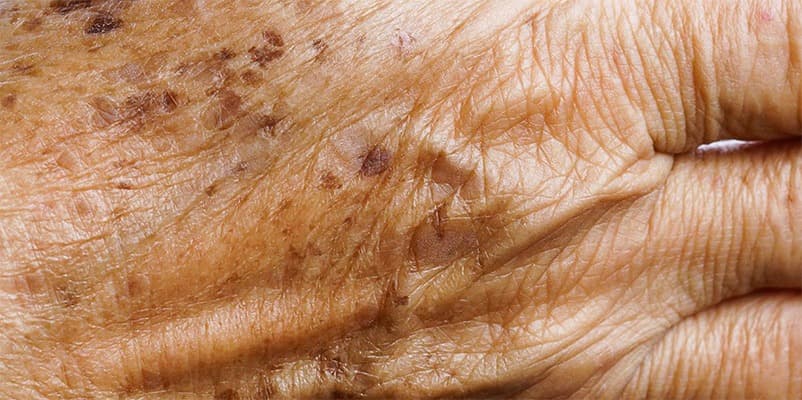 Taches brunes sur une main en gros plan