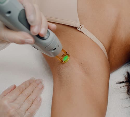 Séance d'épilation laser des aisselles par le Dr Emma Lavocat à Bordeaux