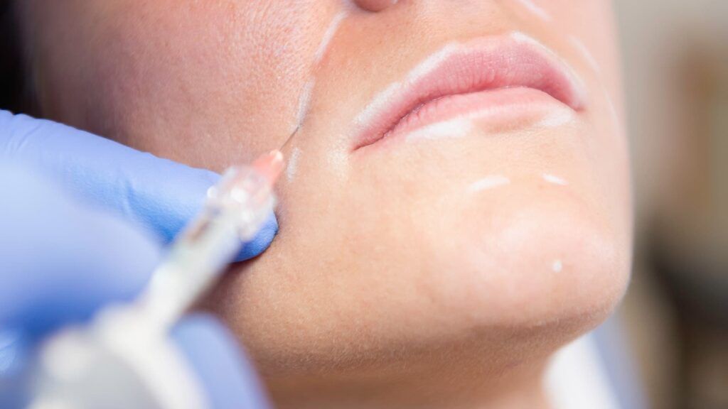 Traitement des rides par acide hyaluronique au sein du cabinet du Dr Emma Lavocat à Bordeaux