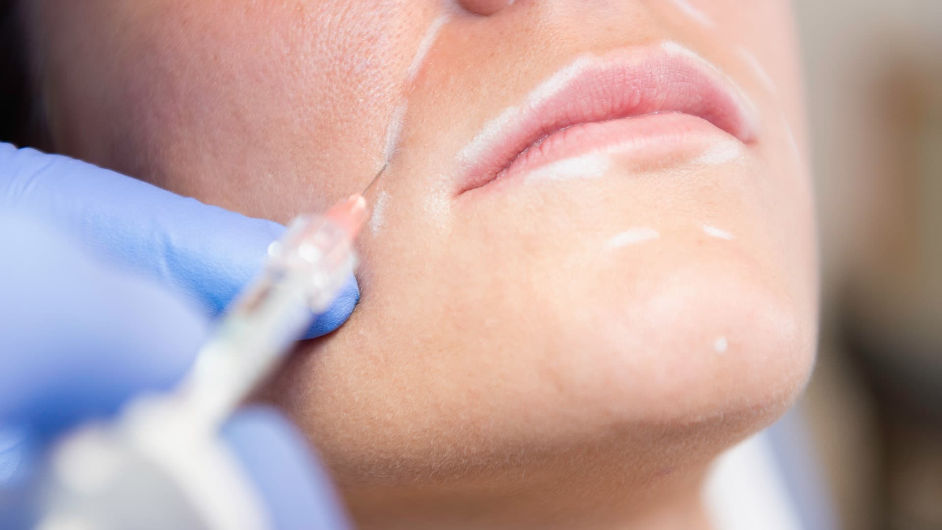 Traitement des rides par acide hyaluronique au sein du cabinet du Dr Emma Lavocat à Bordeaux