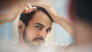 Un homme se regardant dans le miroir en appliquant un produit favorisant la repousse des cheveux qu'il semble perdre par endroit