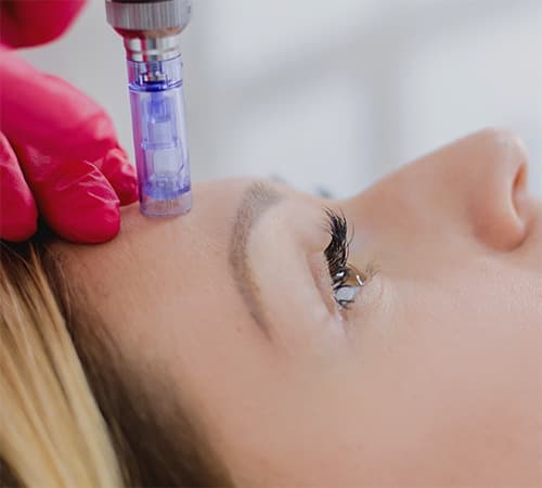 Patiente recevant un traitement par mésothérapie par le Dr Emma Lavocat à Bordeaux