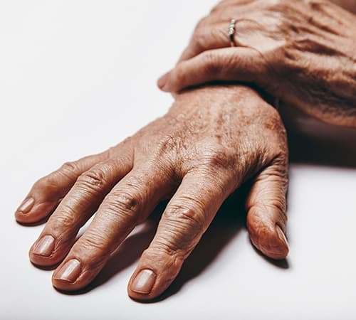 Gros plan sur les mains d'une patiente senior présentant pas mal de taches de vieillesse