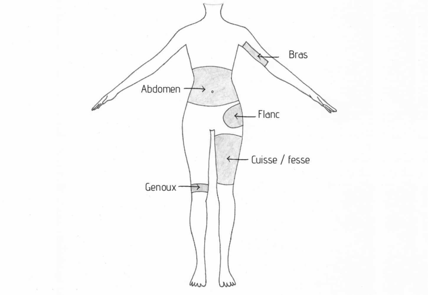 Schéma illustrant les zones de traitement par Velashape au sein du cabinet du Dr Emma Lavocat à Bordeaux